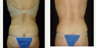 CoolSculpting before and after photo