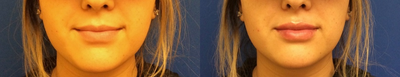 Dermal Fillers before and after photo