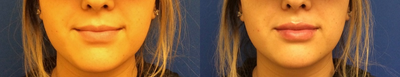Dermal Fillers before and after photo