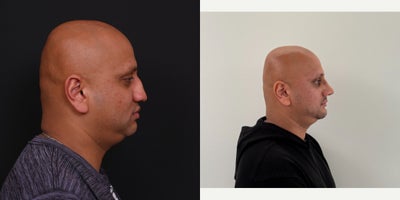 Revision Rhinoplasty before and after photo