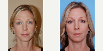 Cheek Augmentation before and after photo