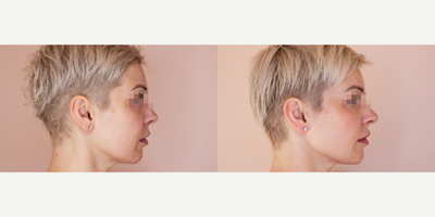 Cheek Fillers before and after photo