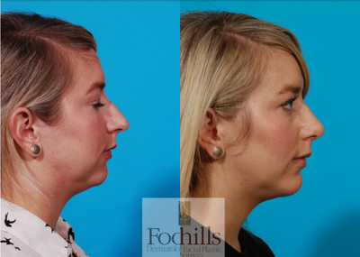 Chin Implant before and after photo