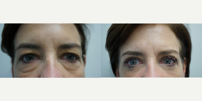 Eyelid Surgery before and after photo