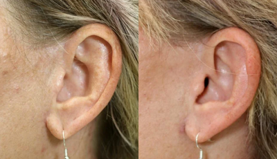 Facelift before and after photo