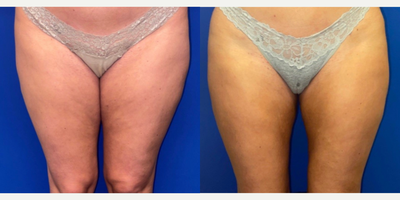 Liposuction before and after photo