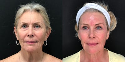 Nonsurgical Facelift before and after photo