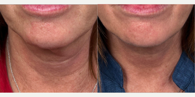 Nonsurgical Neck Lift before and after photo
