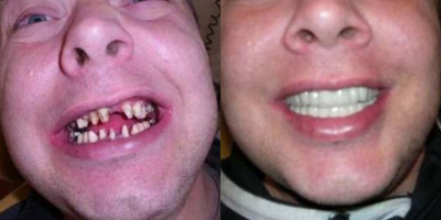 Dental Implants before and after photo