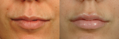 Dermal Fillers before and after photo