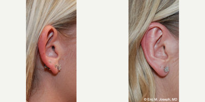 Ear Surgery before and after photo