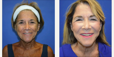 Laser Resurfacing before and after photo