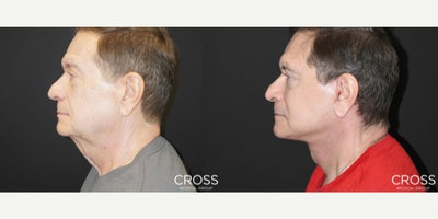 Lower Facelift before and after photo