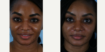 African American Rhinoplasty before and after photo