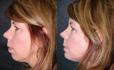 Chin Implant before and after photo