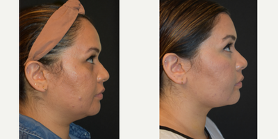 Chin Liposuction before and after photo