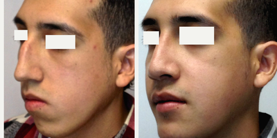 Jaw Surgery before and after photo