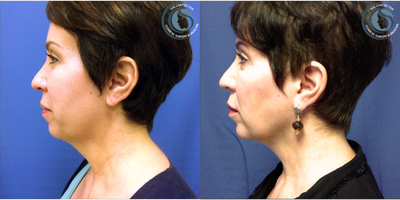 Neck Lift before and after photo