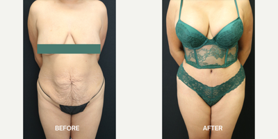 Tummy Tuck before and after photo