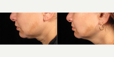 Ultherapy before and after photo