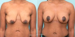 Breast Augmentation before and after photo