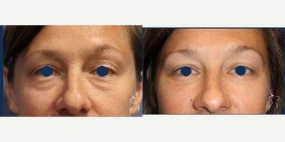 Double Eyelid Surgery before and after photo
