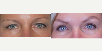 Eyelid Surgery before and after photo