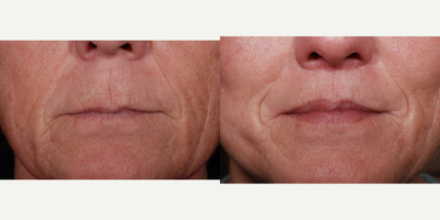 Lip Lift before and after photo