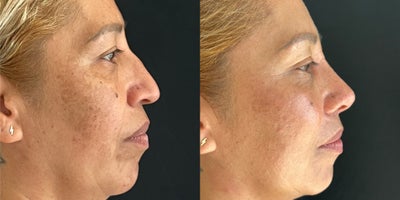 Rhinoplasty before and after photo