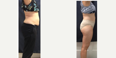 SculpSure before and after photo