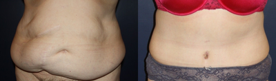 Tummy Tuck before and after photo