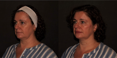 Botox before and after photo