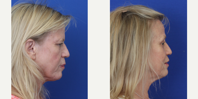 Double Eyelid Surgery before and after photo