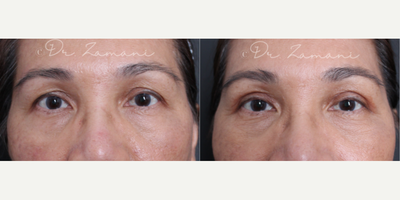 Eyelid Surgery before and after photo