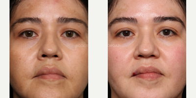 Laser Resurfacing before and after photo