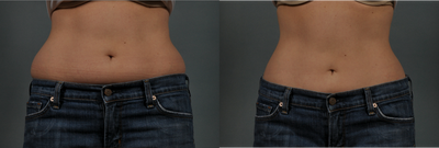 Liposuction before and after photo