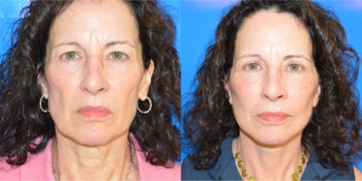 Neck Lift before and after photo