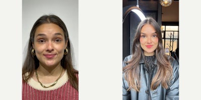 Botox before and after photo