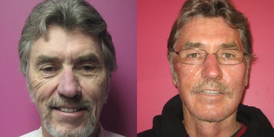 CO2 Laser before and after photo
