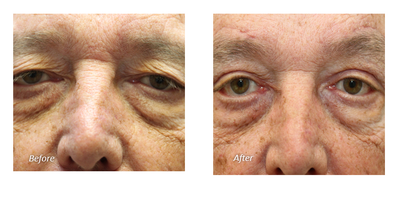 Facelift before and after photo