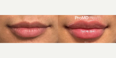 Lip Fillers before and after photo