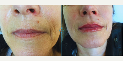 Lip Fillers before and after photo