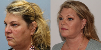 Neck Lift before and after photo