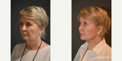 Neck Lift before and after photo