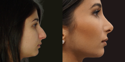 Rhinoplasty before and after photo