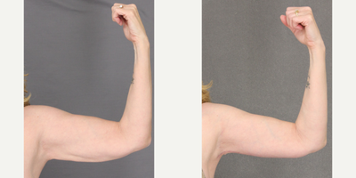 Arm Lift before and after photo