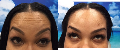 Dysport before and after photo