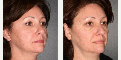 Eyelid Surgery before and after photo