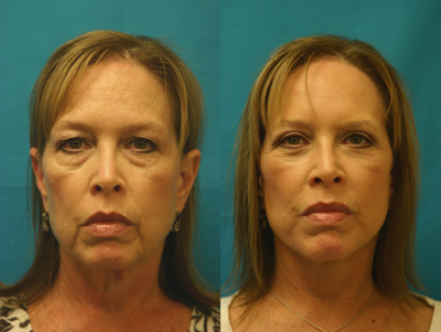 Facelift before and after photo