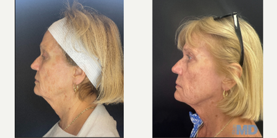 FaceTite before and after photo
